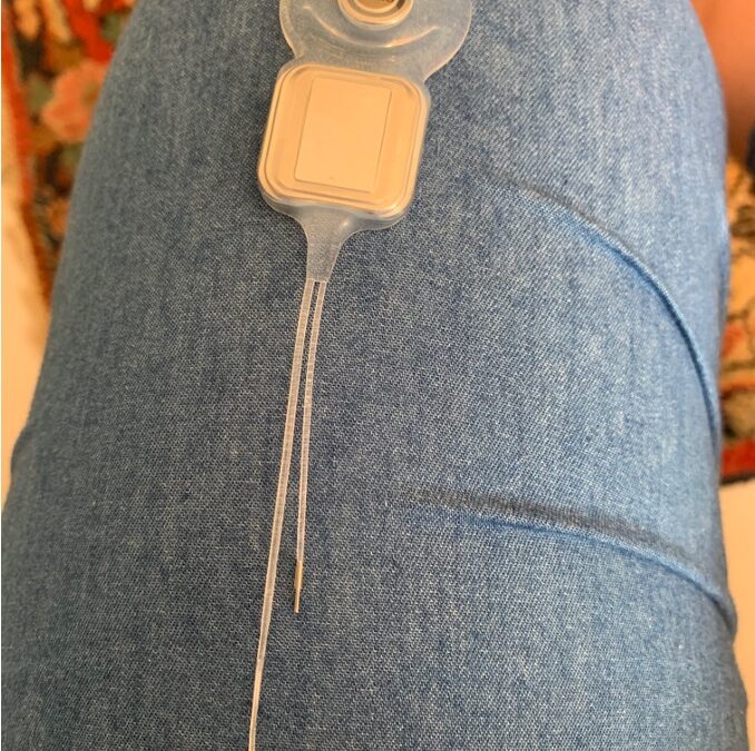 Cochlear implantation – Part 1 of 2
